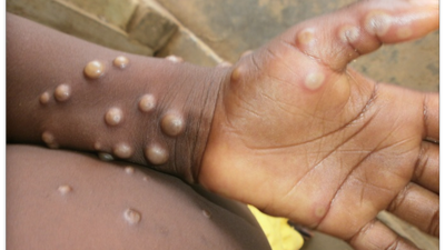 England reports 36 new cases of monkeypox as new virus quickly spreads around the world