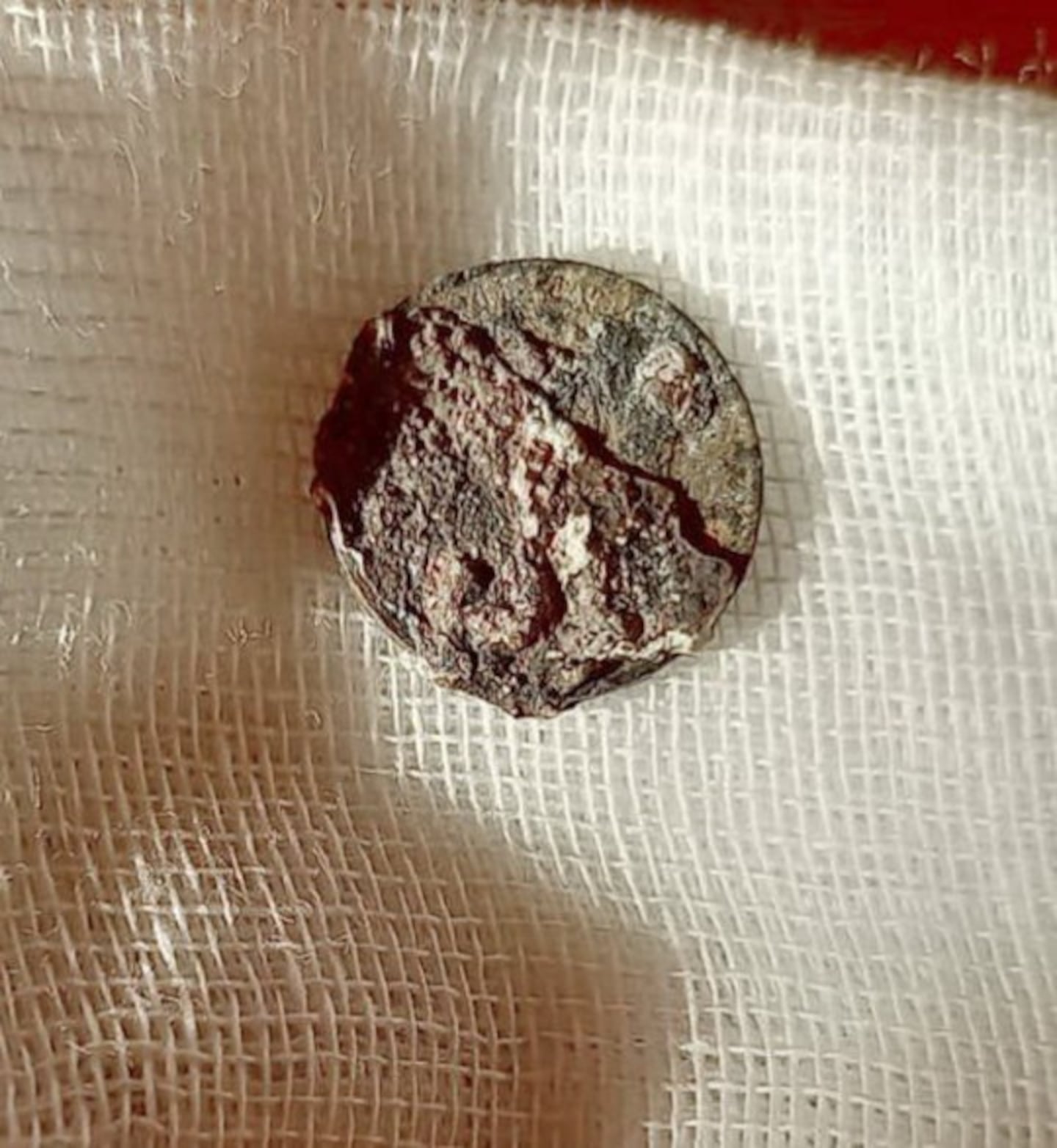 Coin surgically removed from Russia man's nose